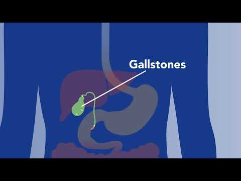 Gallstones